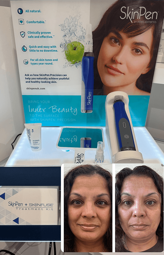 Skinpen 1