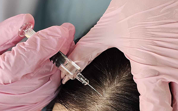 Microneedling for Hair Loss