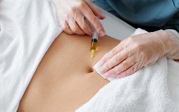 Microneedling for Stretch Marks