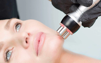 RF Microneedling