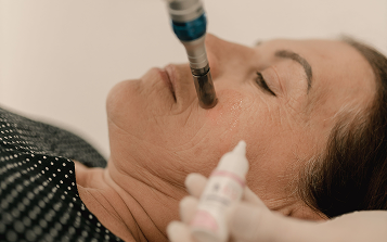 SkinPen Microneedling