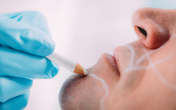 Smokers Lines Treatment